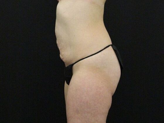 Tummy Tuck: Case 82 - Before
