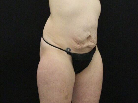 Tummy Tuck Case 82 - Before