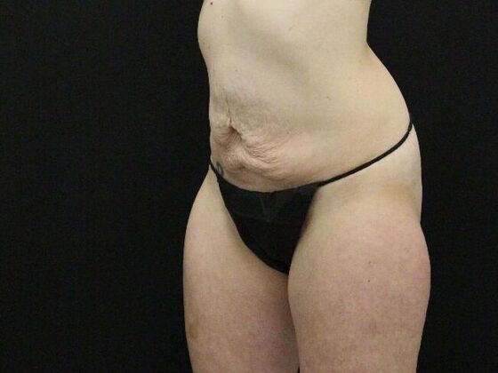 Tummy Tuck: Case 82 - Before