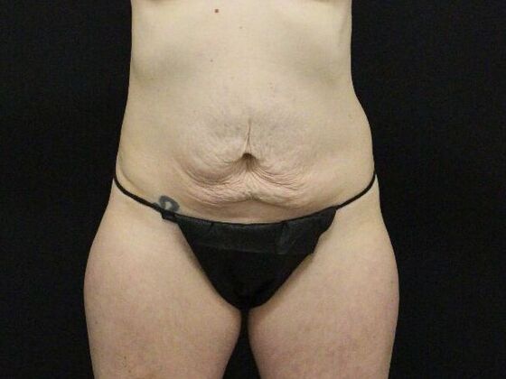 Tummy Tuck: Case 82 - Before