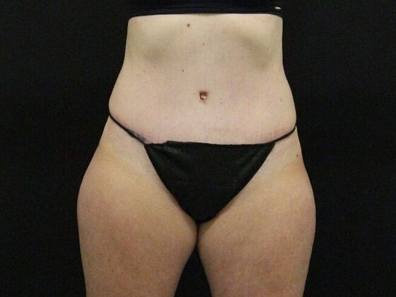 Tummy Tuck: Case 82 - After