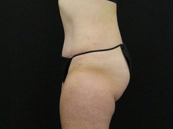 Tummy Tuck: Case 82 - After