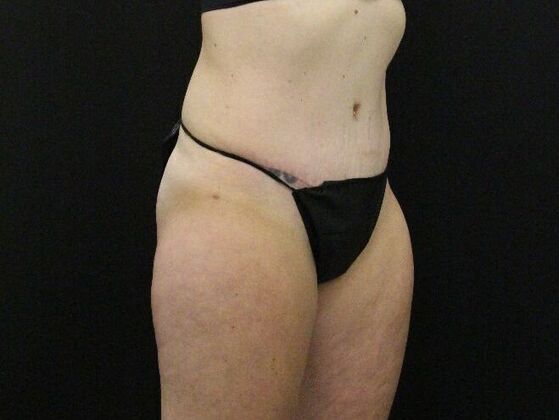 Tummy Tuck Case 82 - After