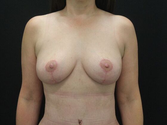 Breast Lift & Breast Lift Augmentation Case 66 - After