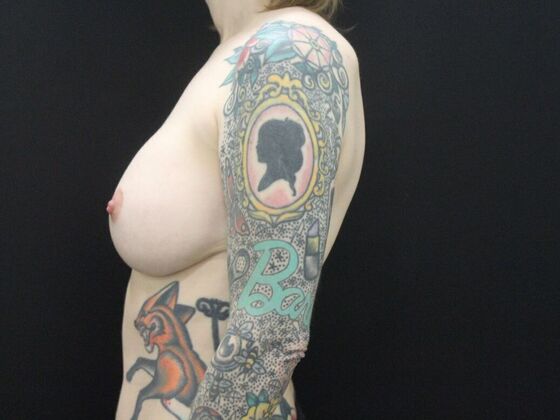 Breast Revision: Case 20 - After