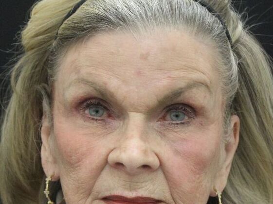 Brow Lift: Case 2 - After