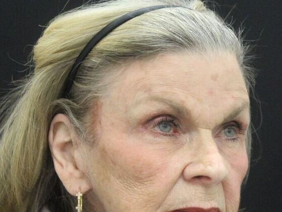 Brow Lift Case 2 - After