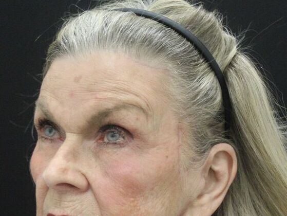 Brow Lift: Case 2 - After