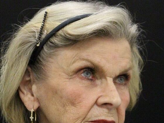 Brow Lift Case 2 - Before