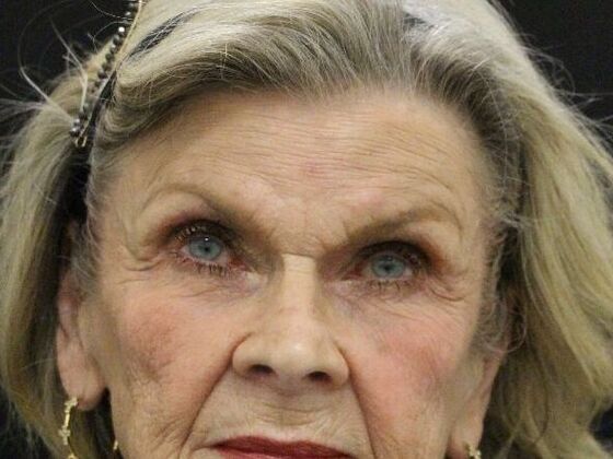 Brow Lift: Case 2 - Before