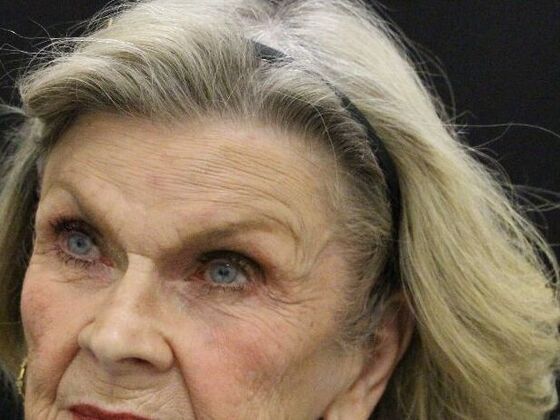 Brow Lift: Case 2 - Before