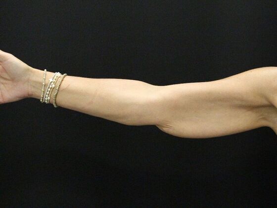 Arm Lift & Reduction: Case 15 - Before