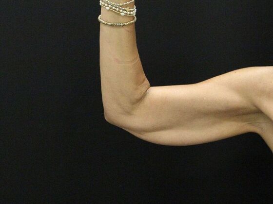 Arm Lift & Reduction Case 15 - Before