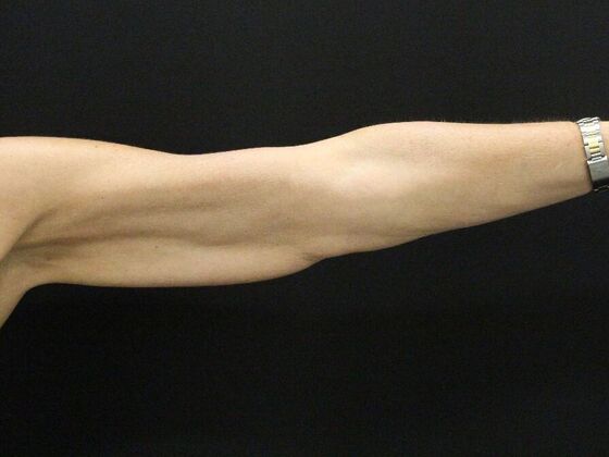 Arm Lift & Reduction: Case 15 - Before
