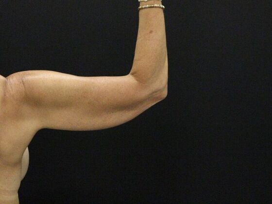 Arm Lift & Reduction: Case 15 - Before