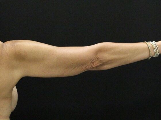 Arm Lift & Reduction: Case 15 - Before