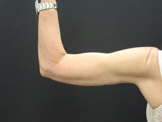 Arm Lift & Reduction: Case 15 - After