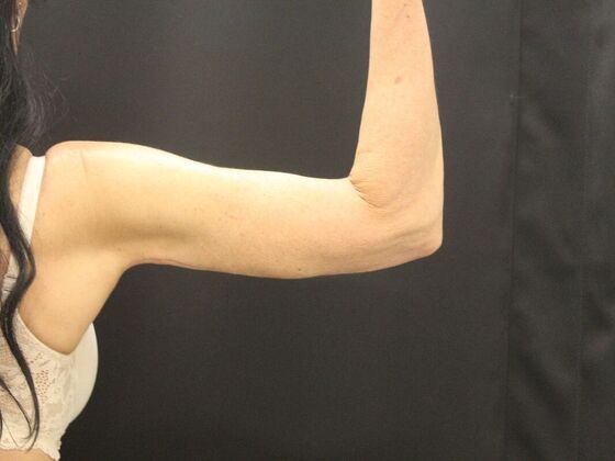 Arm Lift & Reduction: Case 15 - After