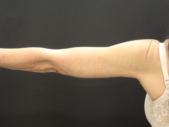 Arm Lift & Reduction: Case 15 - After
