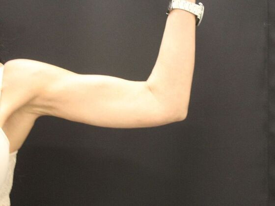 Arm Lift & Reduction: Case 15 - After