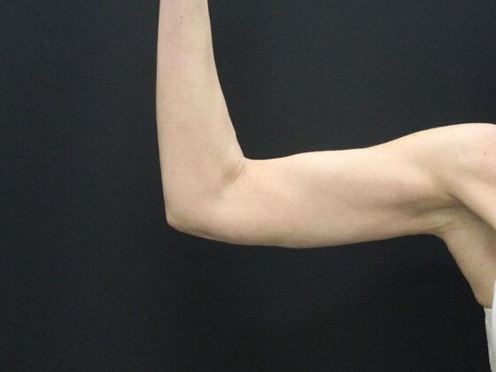 Arm Lift & Reduction Case 15 - After