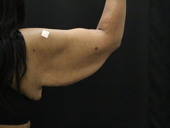 Arm Lift & Reduction: Case 16 - Before