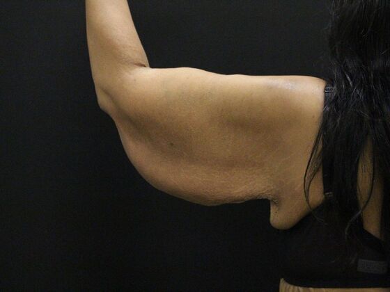 Arm Lift & Reduction: Case 16 - Before