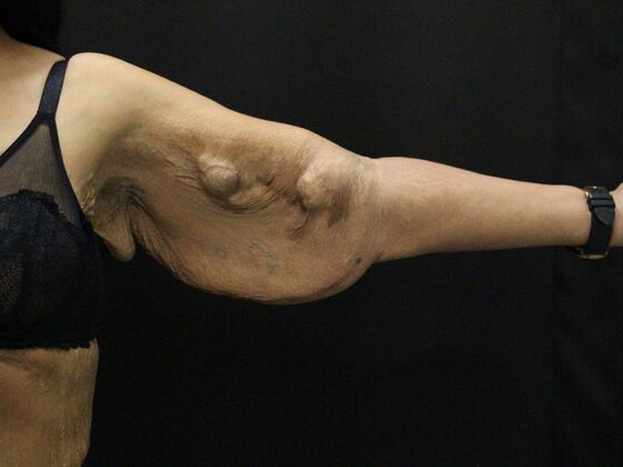 Arm Lift & Reduction: Case 16 - Before