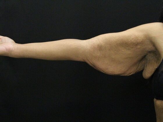 Arm Lift & Reduction: Case 16 - Before