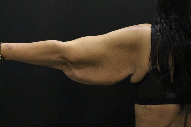 Arm Lift & Reduction: Case 16 - Before