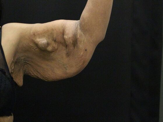 Arm Lift & Reduction: Case 16 - Before