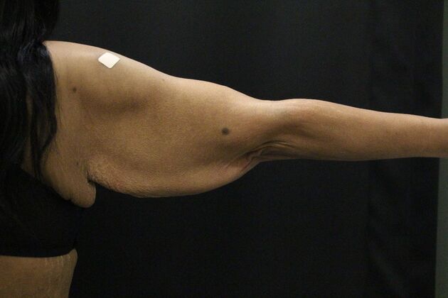 Arm Lift & Reduction: Case 16 - Before