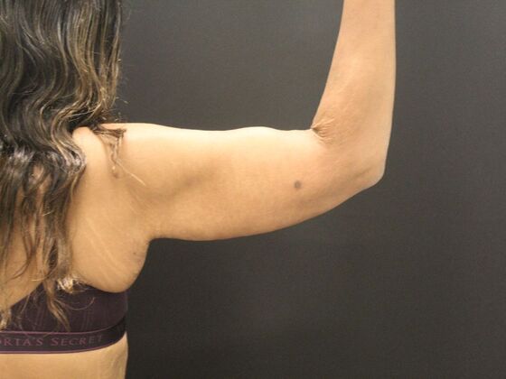 Arm Lift & Reduction: Case 16 - After