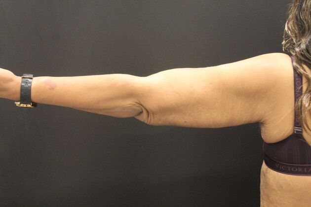 Arm Lift & Reduction: Case 16 - After