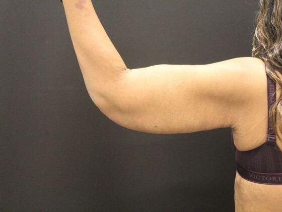 Arm Lift & Reduction: Case 16 - After