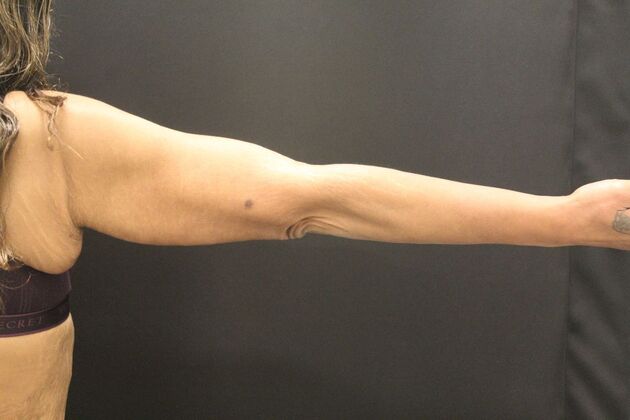 Arm Lift & Reduction: Case 16 - After