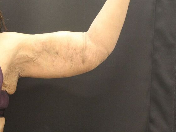 Arm Lift & Reduction: Case 16 - After