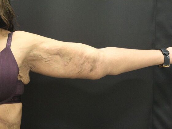 Arm Lift & Reduction: Case 16 - After