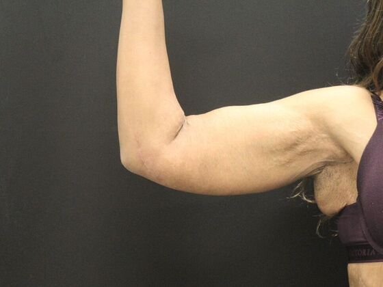 Arm Lift & Reduction Case 16 - After