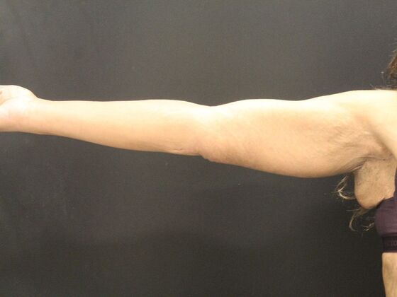 Arm Lift & Reduction: Case 16 - After