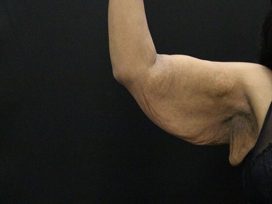 Arm Lift & Reduction Case 16 - Before