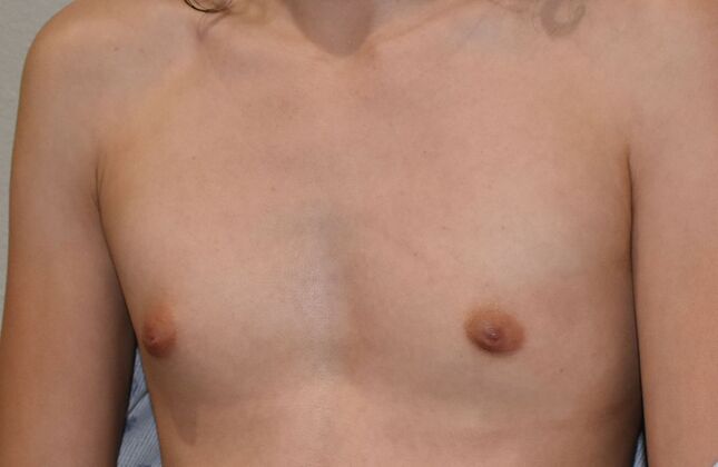 Breast Augmentation: Case 7 - Before