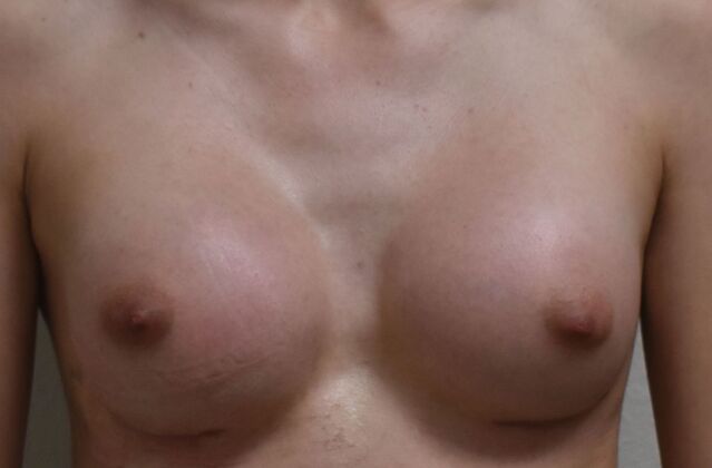 Breast Augmentation Case 7 - After