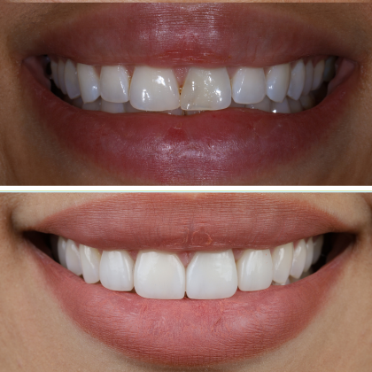 Minimal Prep Porcelain Veneers Melanie - Before