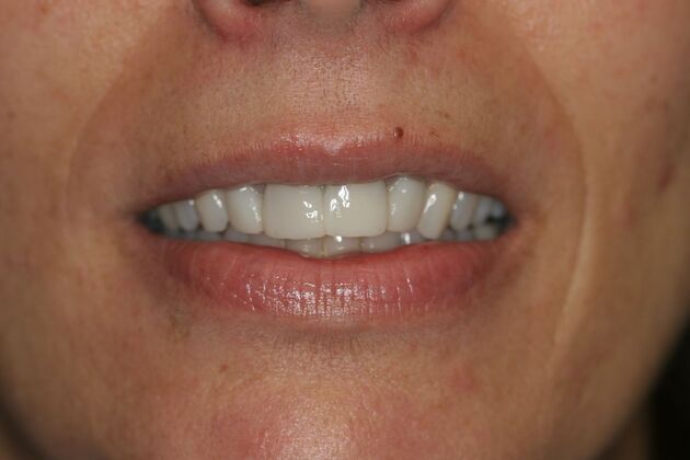 Porcelain Veneers Case 3 - North Haledon, NJ - After