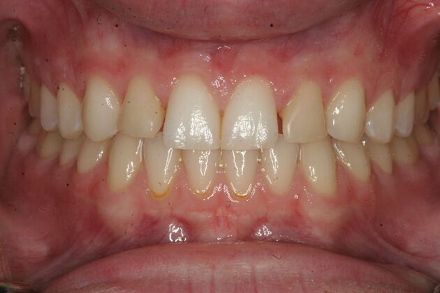 Porcelain Veneers Case 4 - Mahwah, NJ - Before