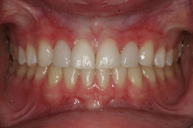 Porcelain Veneers Case 4 - Mahwah, NJ - After