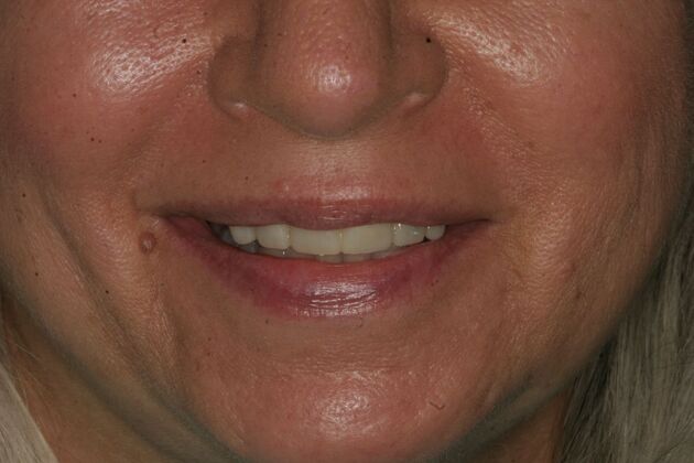 Porcelain Veneers Case 5 - Secaucus, NJ - After