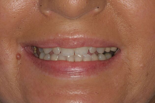 Porcelain Veneers Case 5 - Secaucus, NJ - Before