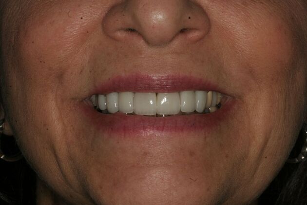 Porcelain Veneers Case 6 - Ridgewood, NJ - After